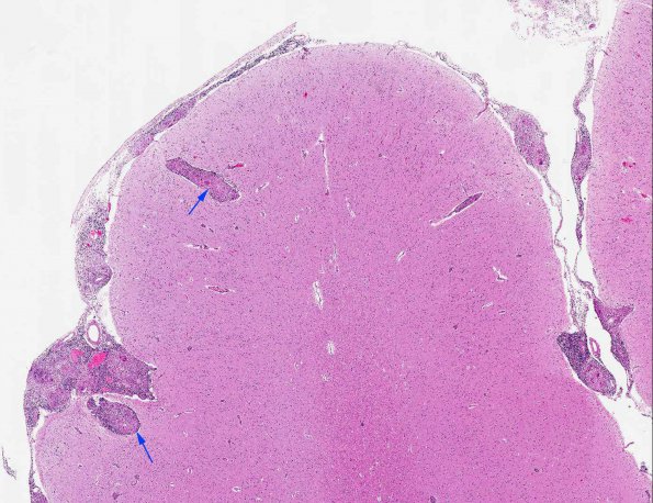 7A1 Neurosarcoidosis (AANP Diagnostic Slide Session 2006, Case 10) H&E 1