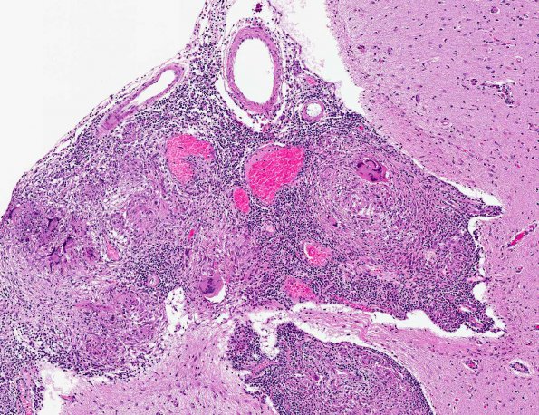 7A2 Neurosarcoidosis (AANP Diagnostic Slide Session 2006, Case 10) H&E 7.4X