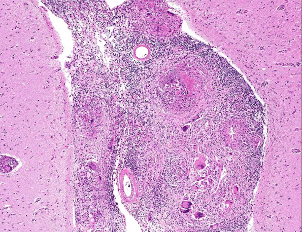 7A3 Neurosarcoidosis (AANP Diagnostic Slide Session 2006, Case 10) H&E 7.4X 2