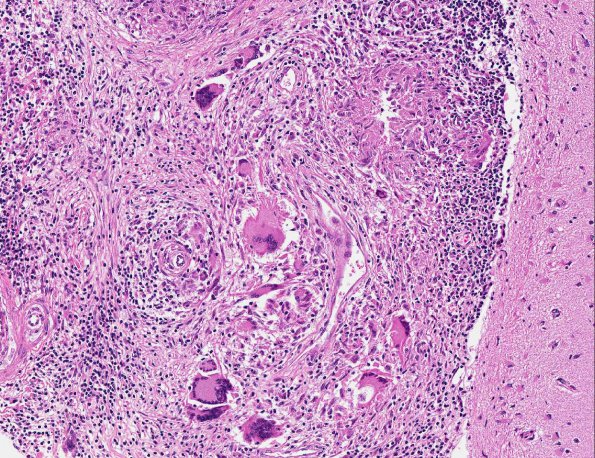 7A4 Neurosarcoidosis (AANP Diagnostic Slide Session 2006, Case 10) H&E 14.4X