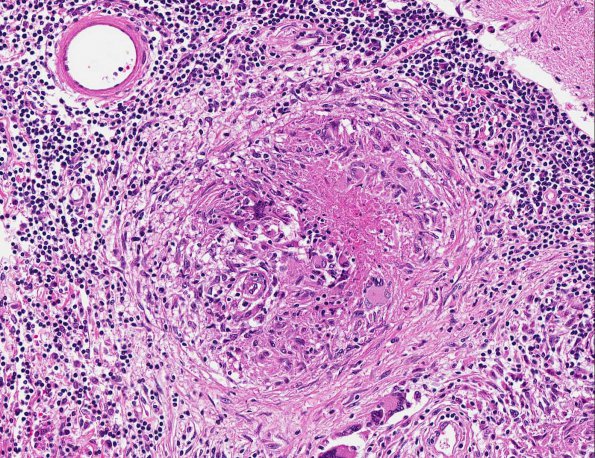 7A5 Neurosarcoidosis (AANP Diagnostic Slide Session 2006, Case 10) H&E 20X 1