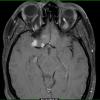 8A1 Neurosarcoid (Case 8) T1 with contrast (3-8-2007) - Copy