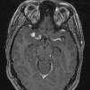 8A2 Neurosarcoid (Case 8) T1 with contrast - Copy