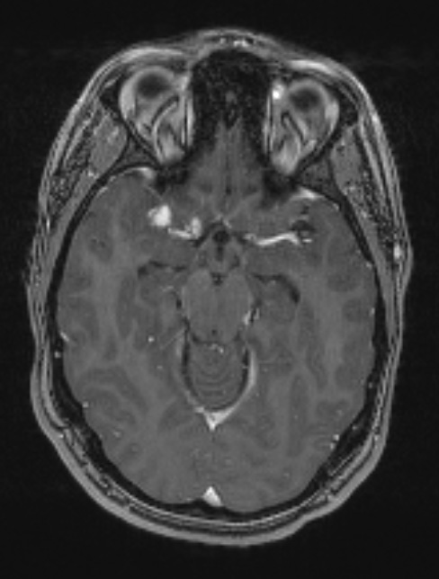 8A2 Neurosarcoid (Case 8) T1 with contrast - Copy