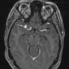 8A3 Neurosarcoid (Case 8) T1 with contrast - Copy 2