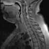 8A4 Neurosarcoidosis (Case 8) MRI 3 - Copy - Copy