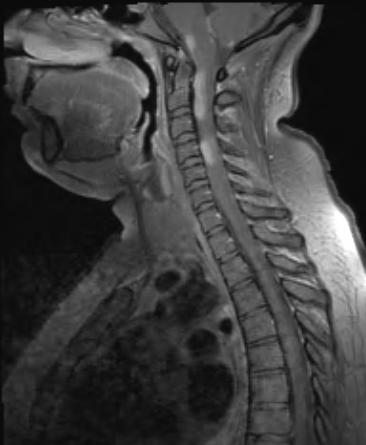 8A4 Neurosarcoidosis (Case 8) MRI 3 - Copy - Copy