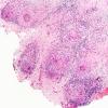 8B1 Neurosarcoidosis (Case 8) H&E low power b