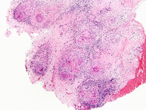 8B1 Neurosarcoidosis (Case 8) H&E low power b