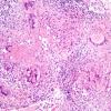 8B2 Neurosarcoidosis (Case 8) H&E necrosis low power 1