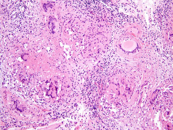 8B2 Neurosarcoidosis (Case 8) H&E necrosis low power 1