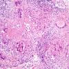 8B3 Neurosarcoidosis (Case 8) H&E necrosis low power