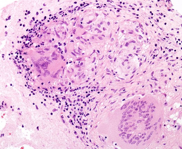 8B4 Neurosarcoidosis (Case 8) H&E 5