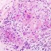 8B5 Neurosarcoidosis (Case 8) H&E 6