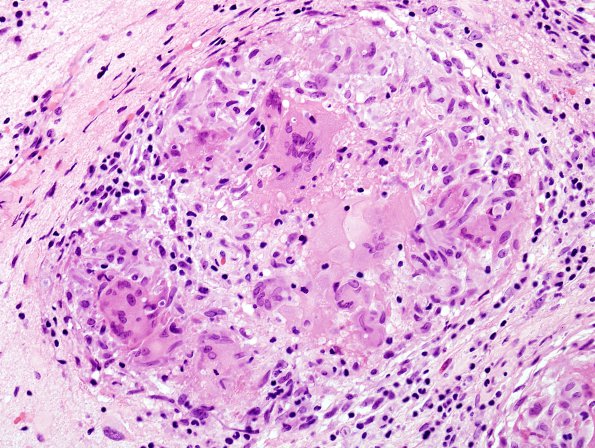 8B5 Neurosarcoidosis (Case 8) H&E 6