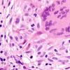 8B6 Neurosarcoidosis (Case 8) H&E granuloma 100x b