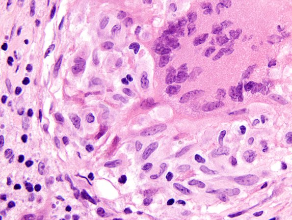 8B6 Neurosarcoidosis (Case 8) H&E granuloma 100x b