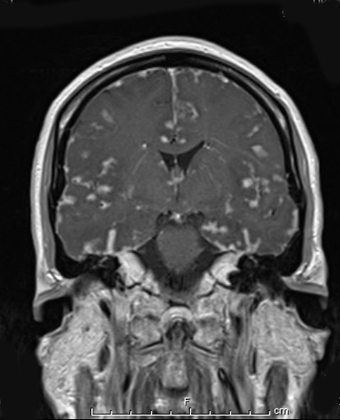 9A2 Sarcoid (granulomatous inflammation with no bugs, Case 9) Coronal T1 post copy - Copy