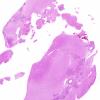 9B1 Sarcoid (granulomatous inflammation with no bugs, Case 9) H&E whole mount