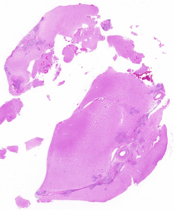 9B1 Sarcoid (granulomatous inflammation with no bugs, Case 9) H&E whole mount