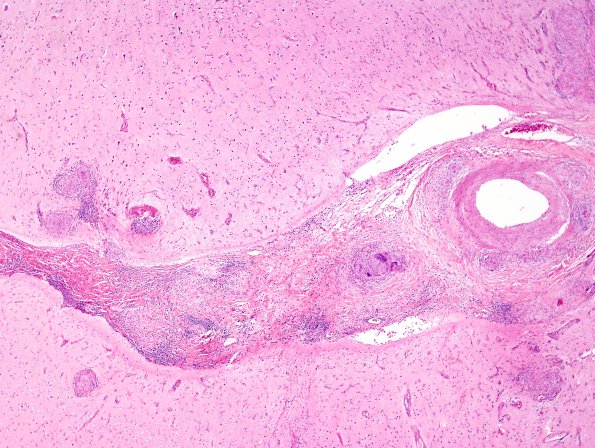 9B3 Sarcoid (granulomatous inflammation with no bugs, Case 9) H&E 1 copy