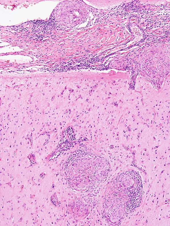 9B4 Sarcoid (granulomatous inflammation with no bugs, Case 9) H&E 4