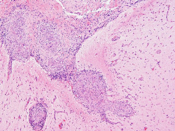 9B5 Sarcoid (granulomatous inflammation with no bugs, Case 9) H&E 11