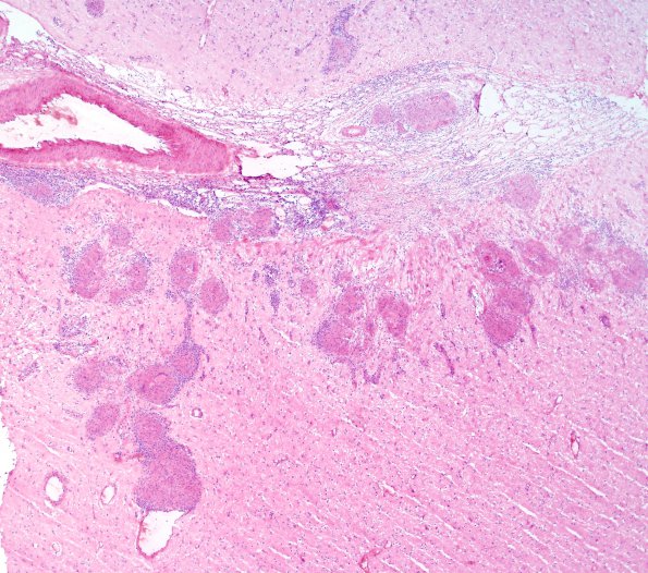 9B6 Sarcoid (granulomatous inflammation with no bugs, Case 9) H&E 17