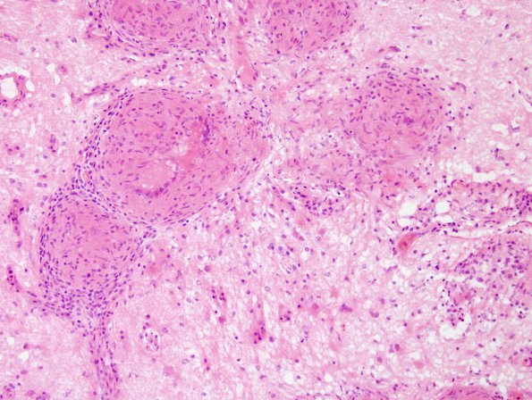 9B7 Sarcoid (granulomatous inflammation with no bugs, Case 9) H&E 15