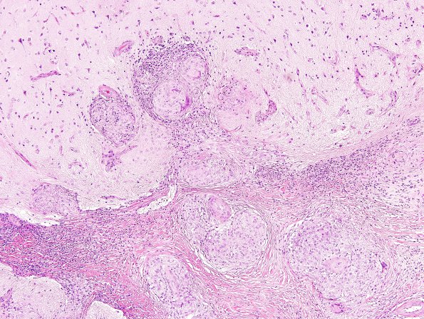 9B8 Sarcoid (granulomatous inflammation with no bugs, Case 9) H&E 21