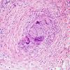 9B9 Sarcoid (granulomatous inflammation with no bugs, Case 9) H&E 6