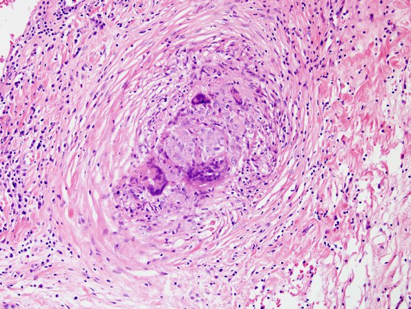 9B9 Sarcoid (granulomatous inflammation with no bugs, Case 9) H&E 6