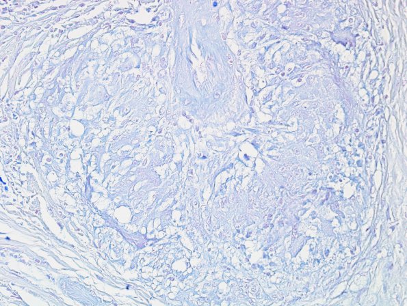 9C1 Sarcoid (granulomatous inflammation with no bugs, Case 9) AFB 1