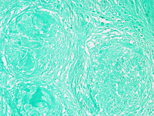 9C2 Sarcoid (granulomatous inflammation with no bugs, Case 9) GMS 1