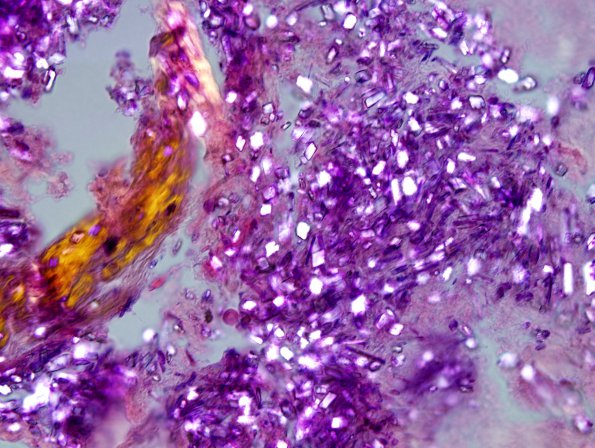 1C2 Calcium pyrophosphate Dihydrate Deposition Dz (Pseudogout, Case 1) H&E 5P