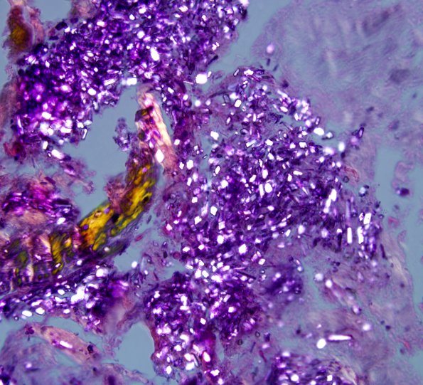 1D2 Calcium pyrophosphate Dihydrate Deposition Dz (Pseudogout, Case 1) H&E 6P