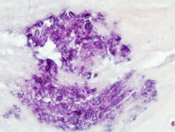 2A2 Pseudogout (Case 2) H&E 26