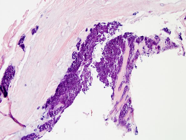 2C1 Pseudogout (Case 2) H&E 21 (non-polarized)