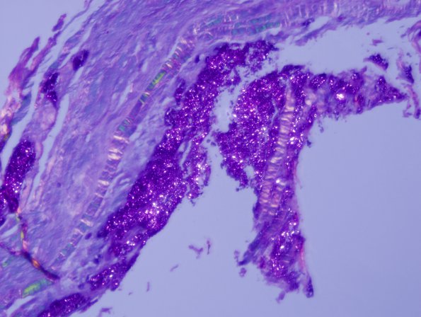 2C2 Pseudogout (Case 2) H&E 21 (polarized)