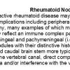 0A Rheumatoid Nodules