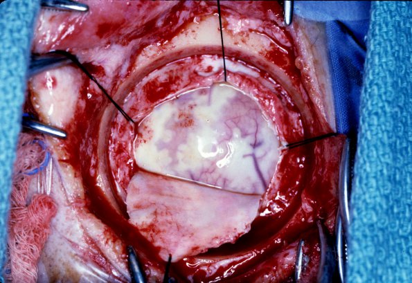 1A1 Rheumatoid Nodules (Case 1) 1