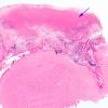 1B1 Rheumatoid nodule, meninges (Case 1) H&E 2 copy