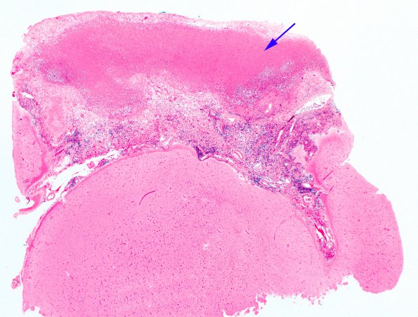 1B1 Rheumatoid nodule, meninges (Case 1) H&E 2 copy