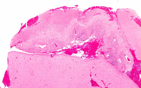 1B3 Rheumatoid nodule, meninges (Case 1) H&E 4