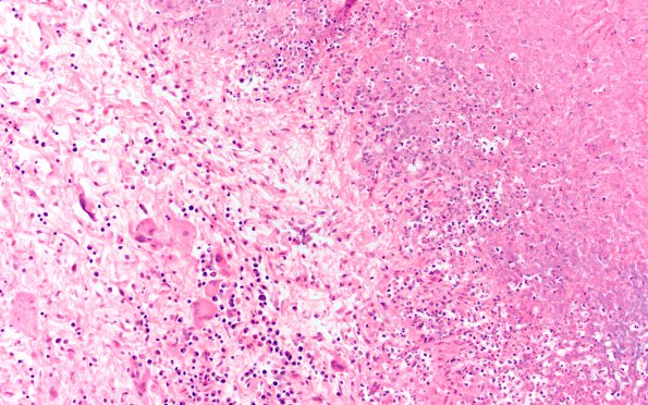 1B4 Rheumatoid nodule, meninges (Case 1) H&E 9