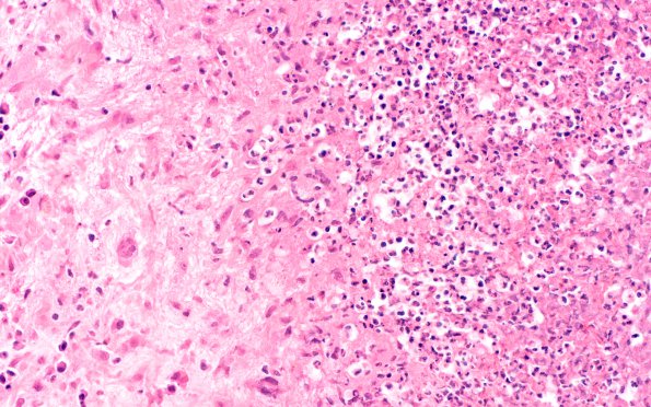 1B5 Rheumatoid nodule, meninges (Case 1) H&E 8