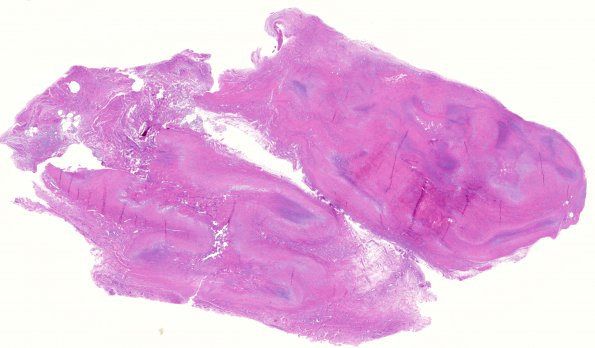 2A1 Rheumatoid nodule, skin (Case 2) H&E whole mount