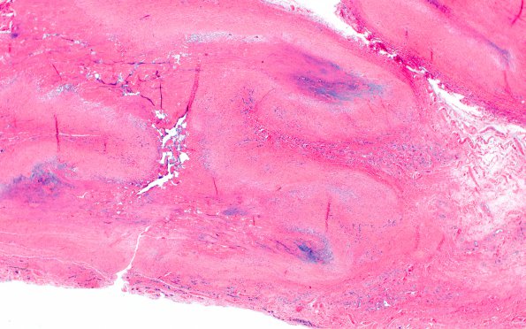 2A2 Rheumatoid nodule, skin (Case 2) H&E 2