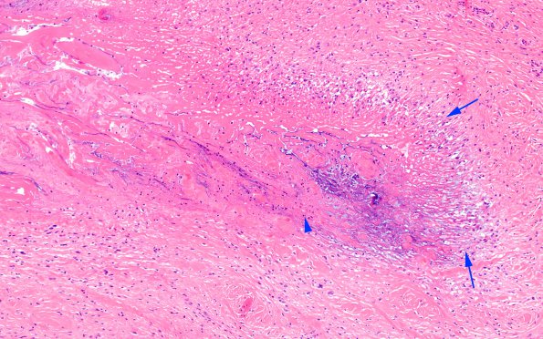 2A3 Rheumatoid nodule, skin (Case 2) H&E 3 copy