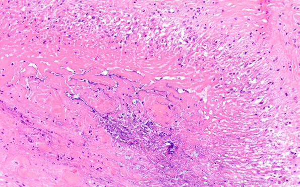 2A4 Rheumatoid nodule, skin (Case 2) H&E 4